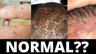 These 3 Things Are Normal After A Hair Transplant [upl. by Eerihs]