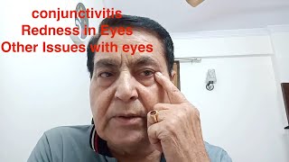 Acupressure points for Redness in Eyes Conjunctivitis Eyeflu By RP Tyagi [upl. by Rance]