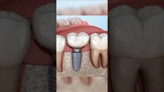 Complete Procedure Of Dental Implant doctor dentist surgeryday medical shorts [upl. by Arakihc593]