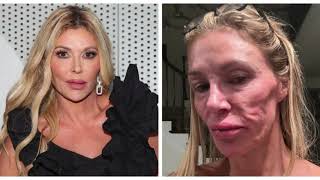 Brandi Glanville Blames Parasite for Her Dramatic Face Change—But Was It Really Bravo [upl. by Drarig211]