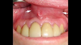 Odontogenic cyst insinuating a nasolabial cyst [upl. by Adnahsed664]