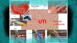 Pus cells Klebsiella in Urine of Urinary tract infection UTI patient [upl. by Mesics]