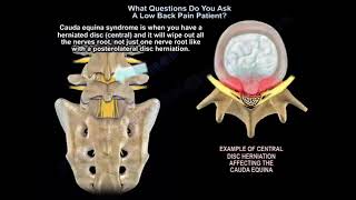 Diagnosing a patient with a complicated condition of low back pain and how it is treated [upl. by Ydnor]