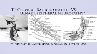 How to Differentiate T1 Cervical Radiculopathy vs Ulnar Nerve Neuropathy Cubital Tunnel Syndrome [upl. by Ilan]