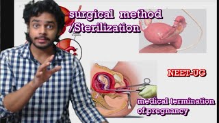 Sterilization vasectomy tubectomy MTP surgical method of contracption  MTP by DrAkash Singh [upl. by Haas927]