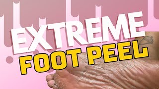 EXTREME Foot Peel demo Achieve BabySoft Feet At Home [upl. by Ennairol]