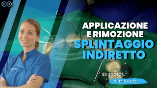 Applicazione e rimozione splintaggio indiretto [upl. by Janik286]