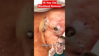 Crazy 10 Year Old BLACKHEADS REMOVAL shorts [upl. by Kcirddahc]