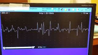 hypoglossal myokymia 3 [upl. by Schafer288]