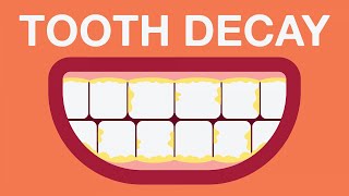 What causes tooth decay [upl. by Laureen574]