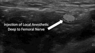 Ultrasound Guided Femoral Nerve Block [upl. by Nessnaj]