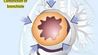 COPD Pathophysiology and Diagnosis [upl. by Spracklen]