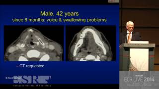 Imaging in hoarseness of voice  HD Basic Radiology [upl. by Emoraj727]