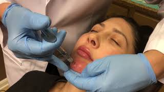 NonSurgical Chin Augmentation using Juvederm Voluma 3cc [upl. by Leyla876]