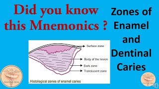 Mnemonics  Histological Zones of Enamel and Dentinal Caries [upl. by Jaunita]