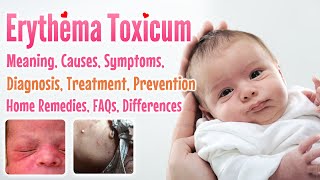 Erythema toxicum overview causes sign and symptoms treatment prevention home remedies FAQs [upl. by Llerahs]