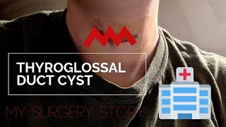 Thyroglossal Cyst Surgery  My Story  Results [upl. by Adnwahsar]