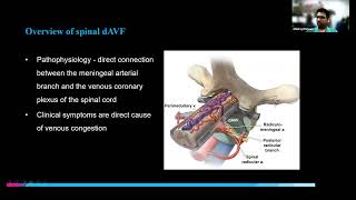 Spine Conference Abhiraj Bhimani MD PGY5 Neurosurgery Resident January 31 2024 [upl. by Milt]