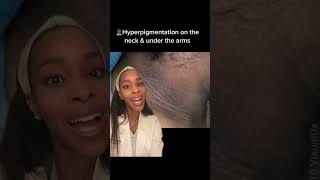 How to get rid of hyperpigmentation on the neck and under the arms [upl. by Justin]