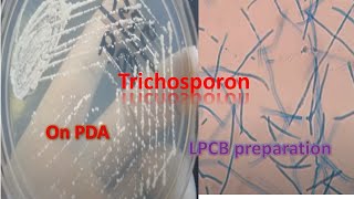 Trichosporon on SDA and LPCB preparation under the microscope [upl. by Bevis244]