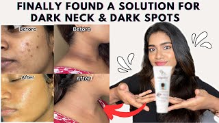 Dark neck amp Hyperpigmentation treatment  Acanthosis Nigricans treatment [upl. by Clarence]