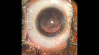 Phaco Surgery in a Posterior Subcapsular Cataract with Acryfold lens under Topical anaesthesia [upl. by Ardnwahsal]