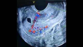 Ultrasound of Ashermans Syndrome [upl. by Messing]