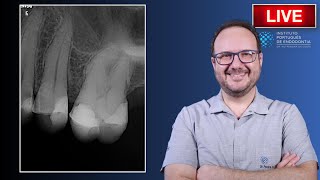 Endo Tx of 🦷25 with Irreversible Pulpitis due to cracked crown ▶️ Part 1  CASE170 [upl. by Kcired682]