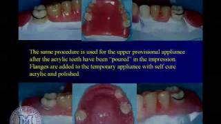 DENT 718 Repairing complete and partial dentures [upl. by Esorbma]