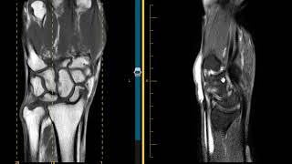 DISI and SLAC wrist scapholunate ligament tear and tenosynovitis [upl. by Lemuela]