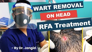 Wart Removal on Head  Live RFA Wart Removal Treatment  Dr Jangid [upl. by Llydnek]