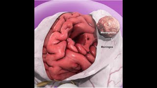 MENINGIOMA WITH extensive extension [upl. by Synned]