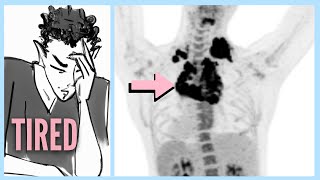 LYMPHOMA After Ignoring 6 WARNING Signs [upl. by Cornie]