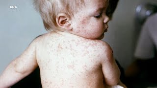 Your child has a viral rash but which one is it Here’s a comparison [upl. by Katrina228]