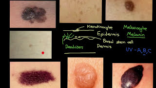 Melanocytic Lesions Part 1 [upl. by Asfah]