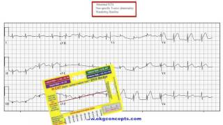 EKG Concepts  12 Lead EKG  Case Study 01 [upl. by Socher]