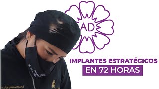 Implantes estratégicos monofásicos [upl. by Cassilda946]