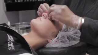 Skin Treatments  Jessner Power Peel HD [upl. by Ellary]