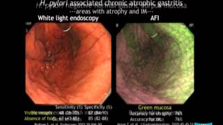 Advanced Imaging in the Diagnosis of Gastric Intestinal Metaplasia The Experts Approach [upl. by Dugan535]