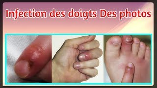 Infection des doigts Des photos [upl. by Aldos386]