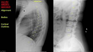 Introduction to Spine Radiographs [upl. by Brinn]