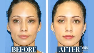 Facial Fat Transfer Results 9 Years Later  Fat Transfer to cheeks under eyes and temples [upl. by Ofori]