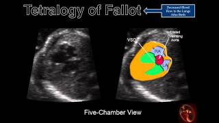 Fetal Echocardiography Tetralogy of Fallot [upl. by Gelasius243]