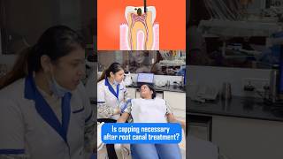 Is capping necessary during root canal treatment 🦷🦷 [upl. by Ursala]