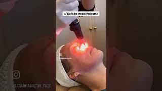 PicoSure Skin Rejuvenation Laser Treatment at Sarah Hamilton FACE [upl. by Yelyah]