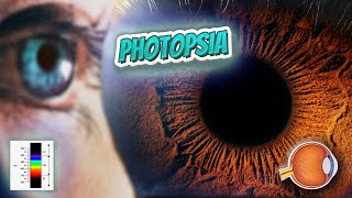 Photopsia  Your EYEBALLS  EYNTK 👁️👁️💉😳💊🔊💯✅ [upl. by Anoj]