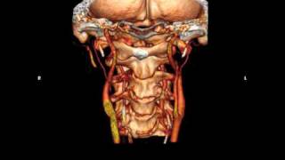 椎骨動脈の解剖学的変異  anomaly of vertevral artery  3D image with Osirix [upl. by Aranahs]