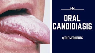 Oral Candidiasis [upl. by Otrebtuc]