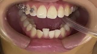 COLOCACION DE BRACKETS METALICOS PASO A PASO [upl. by Shiekh]