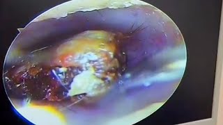 Cleaning of oversized external auditory canal cholesteatoma earwax Cleaning earwaxremoval [upl. by Assyram]